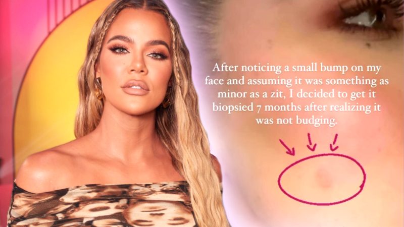 'I was lucky': Khloe Kardashian reveals why she had immediate surgery on her face