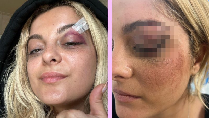 Bebe Rexha shares an update of her nasty wounds after being struck by a fan's phone mid-concert