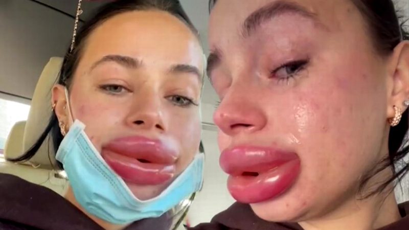 'Something bad happened': Influencer shares warning after her lip fillers go oh so wrong 